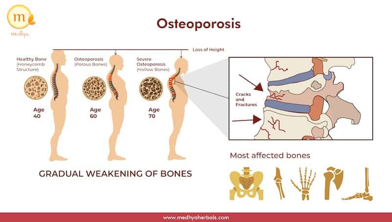 ayurvedic natural treatment for osteoporosis