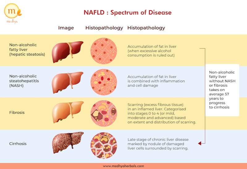 Fatty Liver-Disease 4 Stages