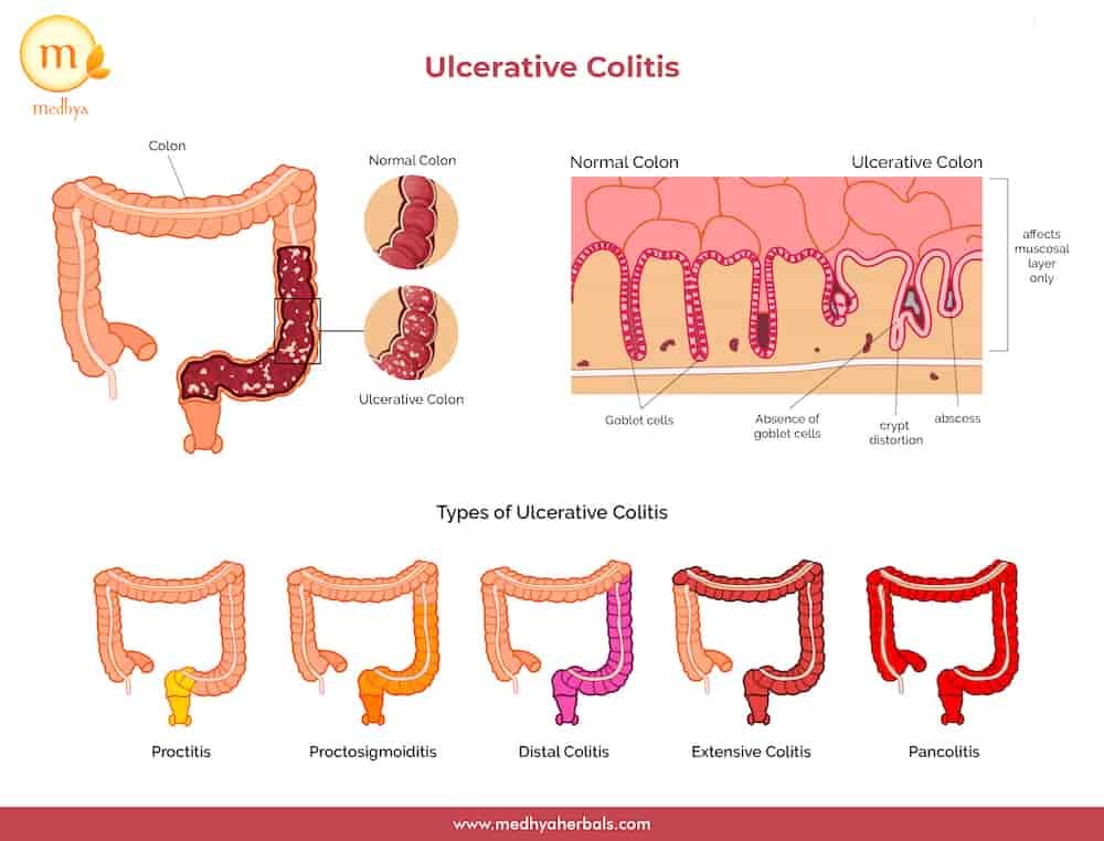 Ulcerative Colitis